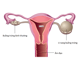 8 dấu hiệu u nang buồng trứng có thể bạn chưa biết